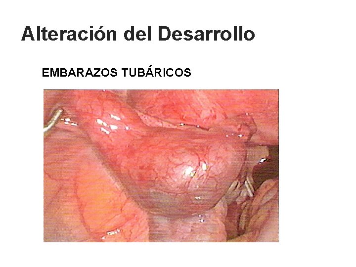 Alteración del Desarrollo EMBARAZOS TUBÁRICOS 