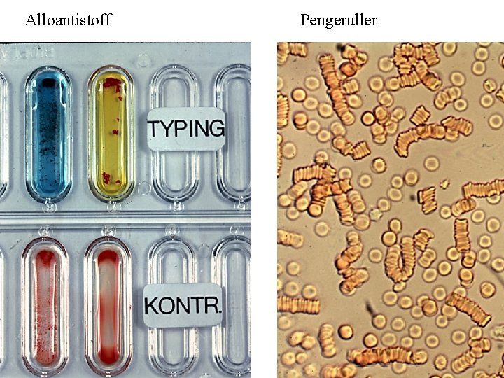 Alloantistoff Pengeruller 