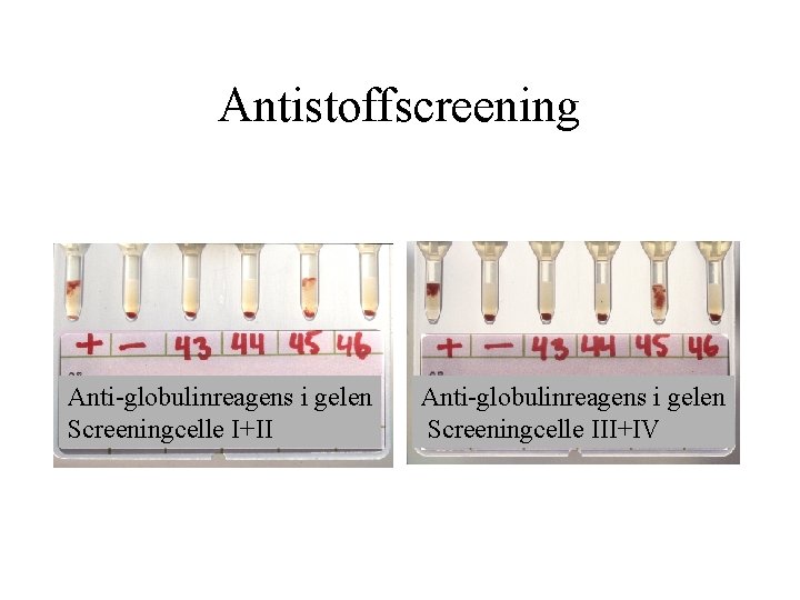 Antistoffscreening Anti globulinreagens i gelen Screeningcelle I+II Anti globulinreagens i gelen Screeningcelle III+IV 
