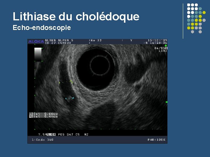 Lithiase du cholédoque Echo-endoscopie 