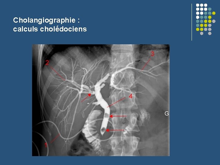 Cholangiographie : calculs cholédociens 