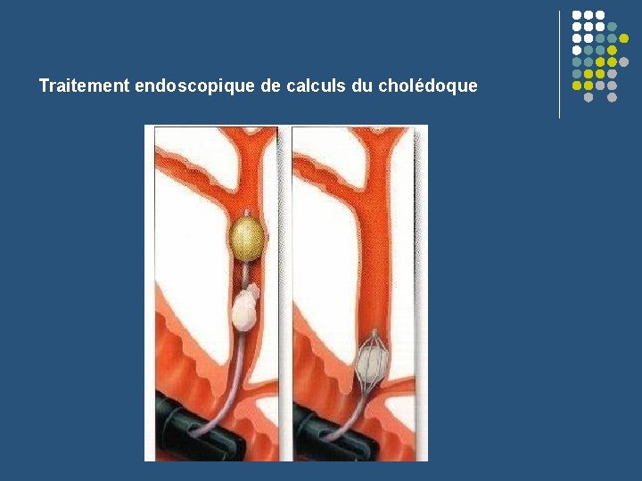 Traitement endoscopique de calculs du cholédoque 