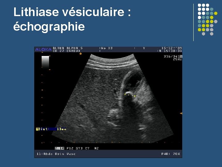 Lithiase vésiculaire : échographie 