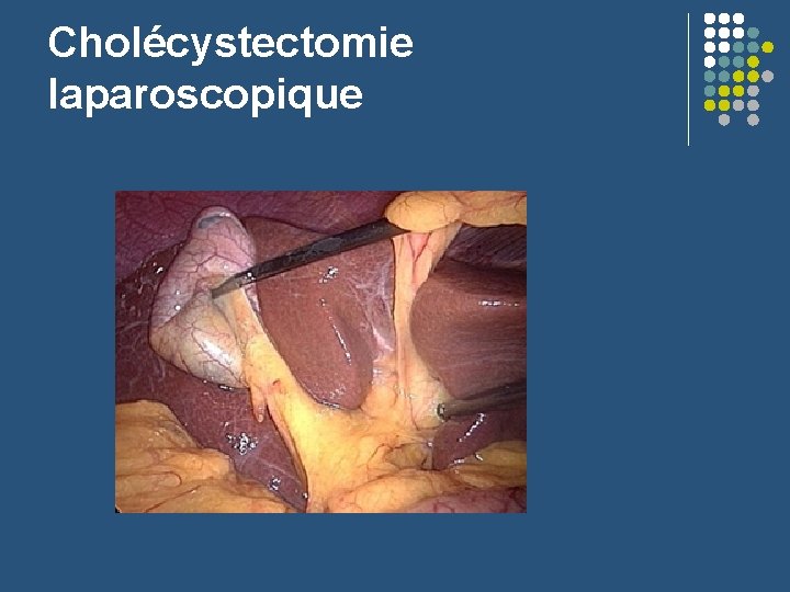 Cholécystectomie laparoscopique 