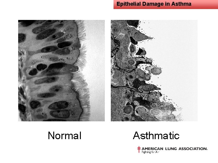 Epithelial Damage in Asthma Normal Asthmatic 