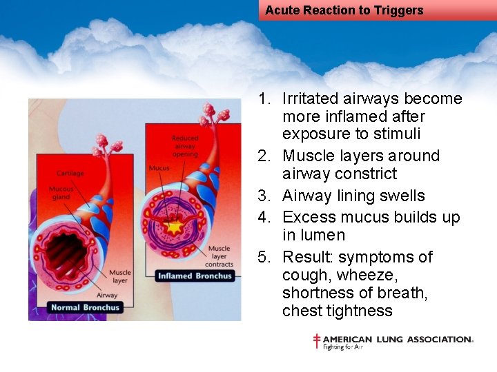 Acute Reaction to Triggers 1. Irritated airways become more inflamed after exposure to stimuli