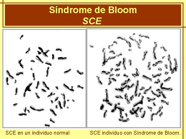 Síndrome de Bloom GENÈTICA MENDELIANA SCE en un individuo normal SCE individuo con Síndrome