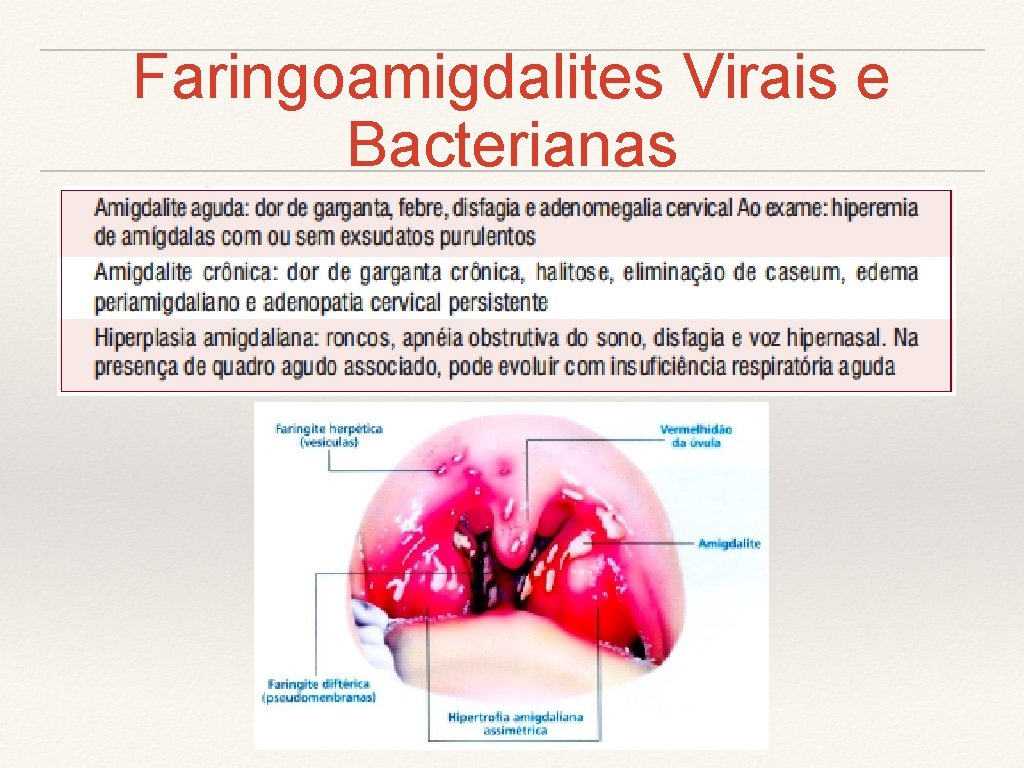 Faringoamigdalites Virais e Bacterianas 