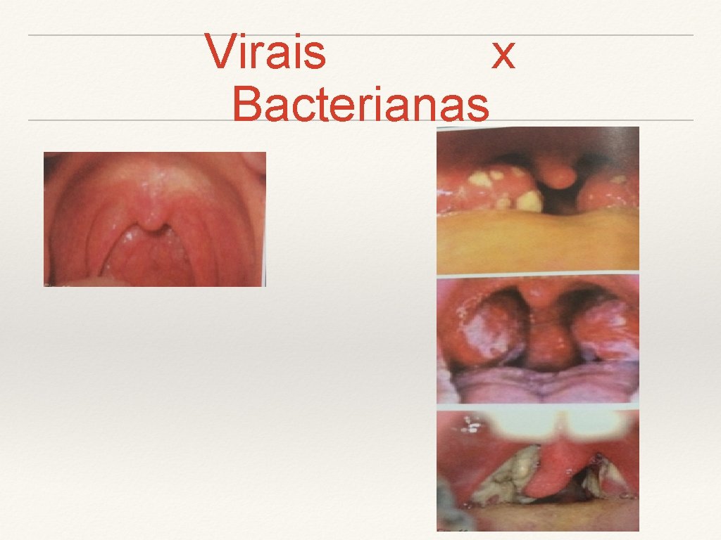 Virais x Bacterianas 