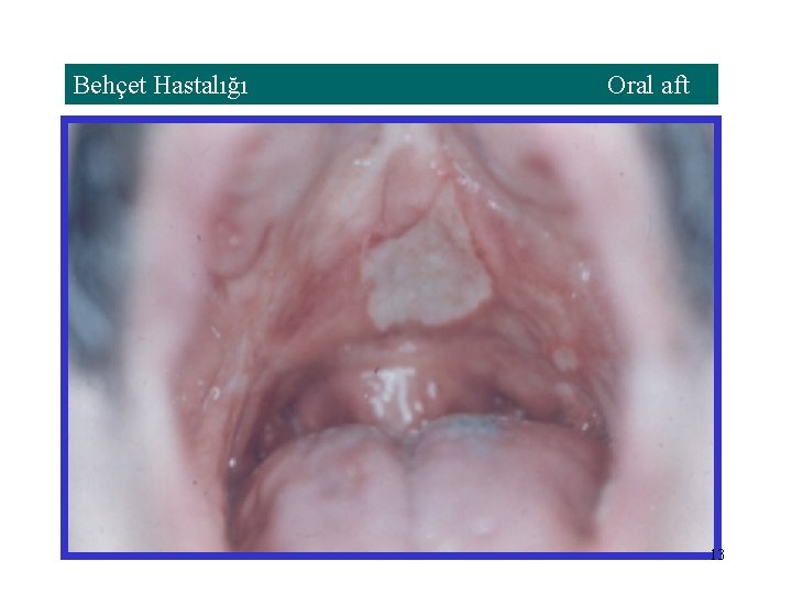 Behçet Hastalığı Oral aft 13 