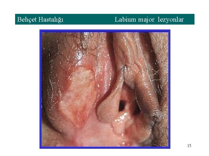 Behçet Hastalığı Labium major lezyonlar 15 