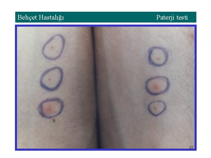 Behçet Hastalığı Paterji testi 21 