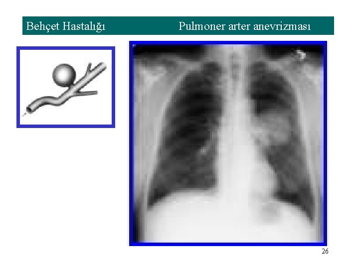 Behçet Hastalığı Pulmoner arter anevrizması 26 