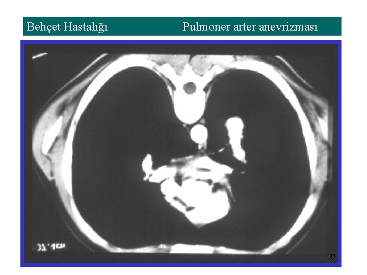 Behçet Hastalığı Pulmoner arter anevrizması 27 