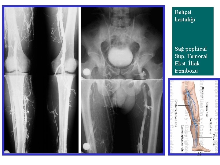 Behçet hastalığı Sağ popliteal Süp. Femoral Ekst. İliak trombozu 32 