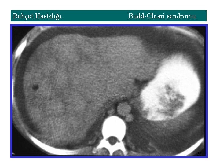 Behçet Hastalığı Budd-Chiari sendromu 33 