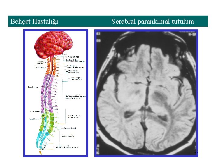 Behçet Hastalığı Serebral parankimal tutulum 35 