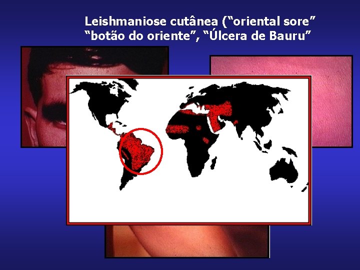 Leishmaniose cutânea (“oriental sore” “botão do oriente”, “Úlcera de Bauru” 