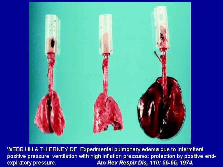 WEBB HH & THIERNEY DF. Experimental pulmonary edema due to intermitent positive pressure ventilation