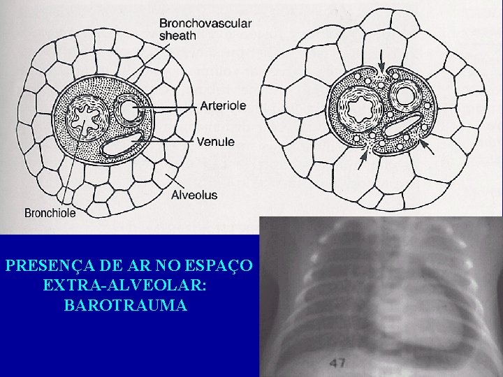 PRESENÇA DE AR NO ESPAÇO EXTRA-ALVEOLAR: BAROTRAUMA 