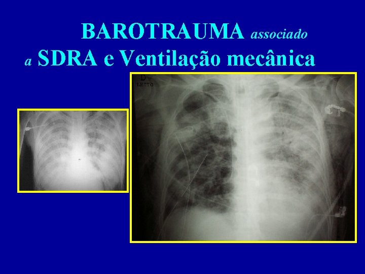 BAROTRAUMA associado a SDRA e Ventilação mecânica 