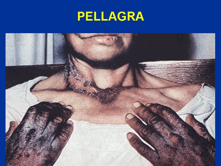 PELLAGRA 