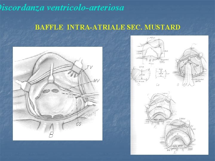 Discordanza ventricolo-arteriosa BAFFLE INTRA-ATRIALE SEC. MUSTARD 