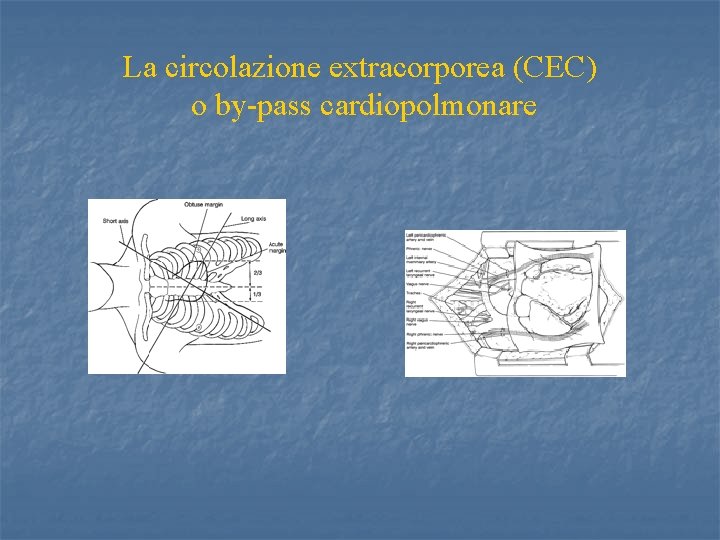 La circolazione extracorporea (CEC) o by-pass cardiopolmonare 