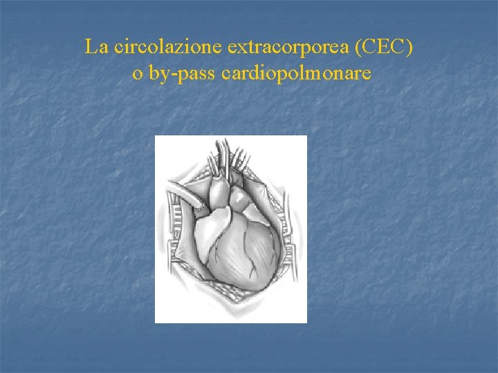 La circolazione extracorporea (CEC) o by-pass cardiopolmonare 