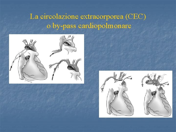 La circolazione extracorporea (CEC) o by-pass cardiopolmonare 