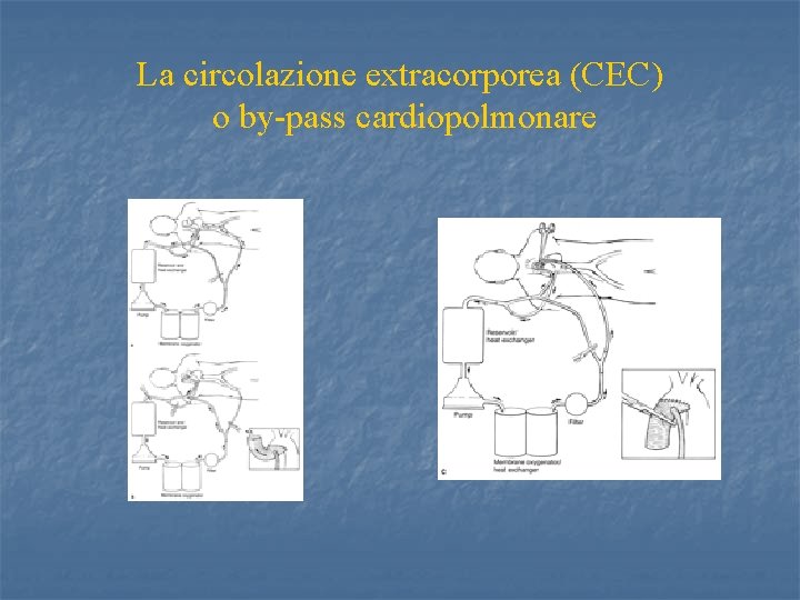 La circolazione extracorporea (CEC) o by-pass cardiopolmonare 