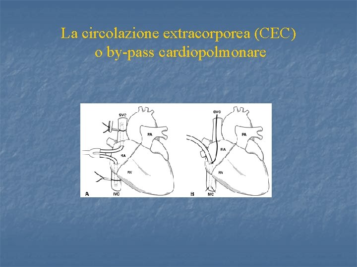 La circolazione extracorporea (CEC) o by-pass cardiopolmonare 