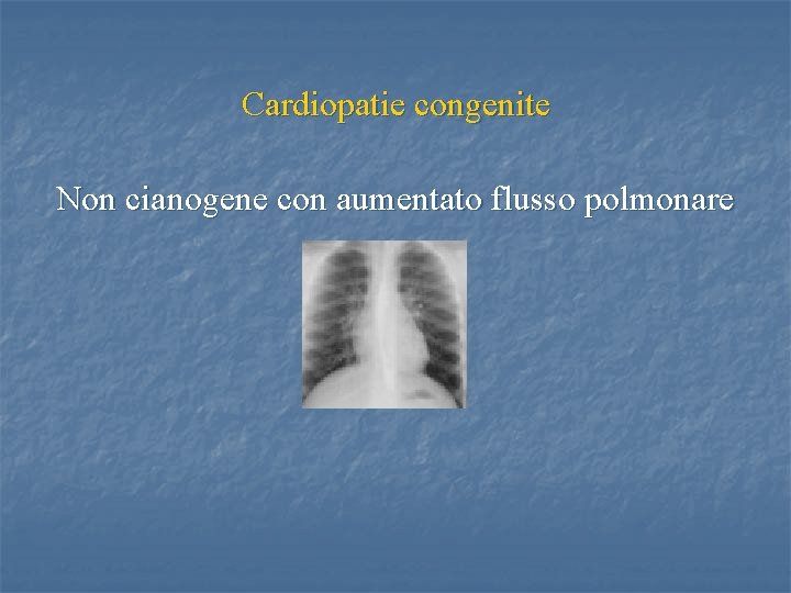 Cardiopatie congenite Non cianogene con aumentato flusso polmonare 
