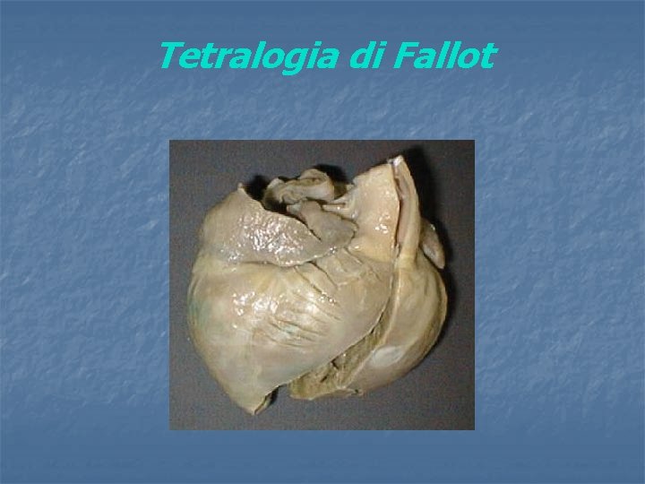 Tetralogia di Fallot 