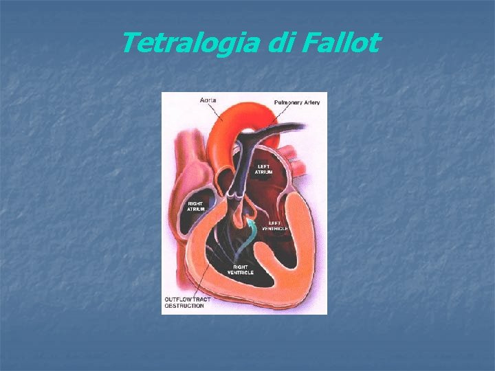 Tetralogia di Fallot 