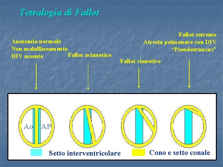 Tetralogia di Fallot Anatomia normale Non malallineamento Fallot acianotico DIV assente Ao Fallot estremo