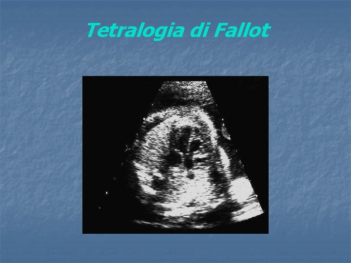 Tetralogia di Fallot 