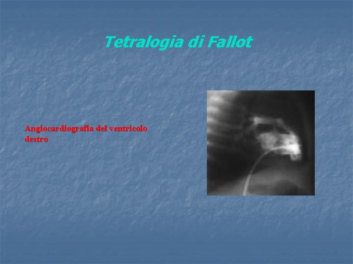 Tetralogia di Fallot Angiocardiografia del ventricolo destro 