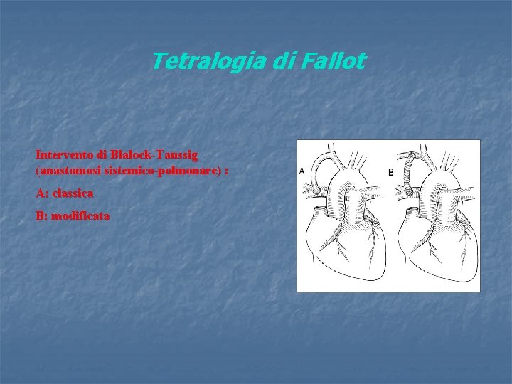 Tetralogia di Fallot Intervento di Blalock-Taussig (anastomosi sistemico-polmonare) : A: classica B: modificata 