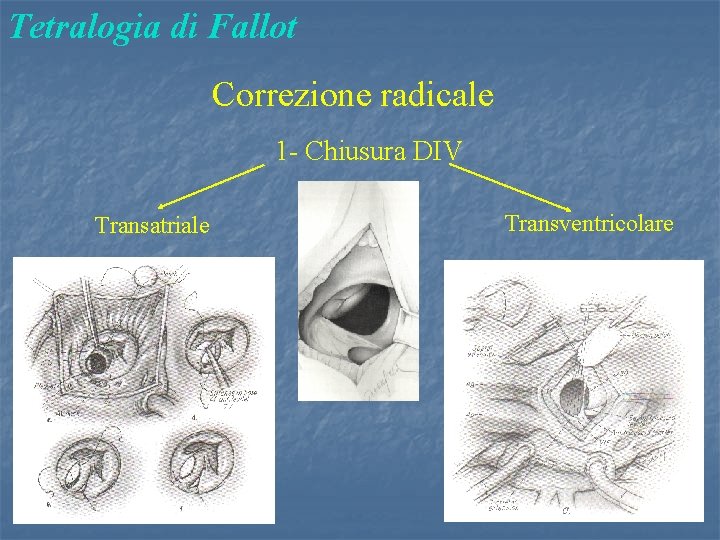 Tetralogia di Fallot Correzione radicale 1 - Chiusura DIV Transatriale Transventricolare 