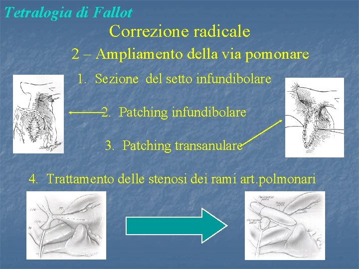 Tetralogia di Fallot Correzione radicale 2 – Ampliamento della via pomonare 1. Sezione del