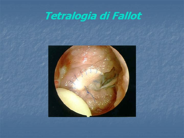 Tetralogia di Fallot 