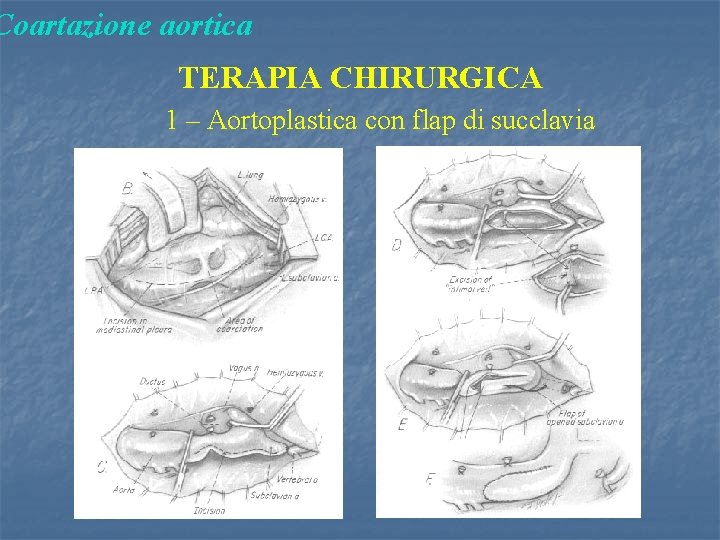 Coartazione aortica TERAPIA CHIRURGICA 1 – Aortoplastica con flap di succlavia 