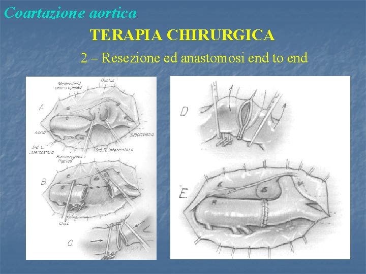 Coartazione aortica TERAPIA CHIRURGICA 2 – Resezione ed anastomosi end to end 