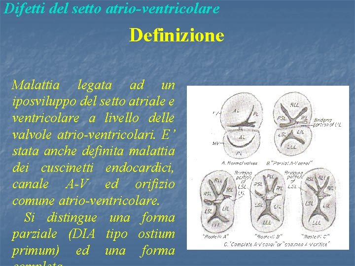 Difetti del setto atrio-ventricolare Definizione Malattia legata ad un iposviluppo del setto atriale e