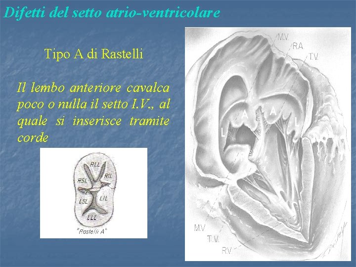 Difetti del setto atrio-ventricolare Tipo A di Rastelli Il lembo anteriore cavalca poco o