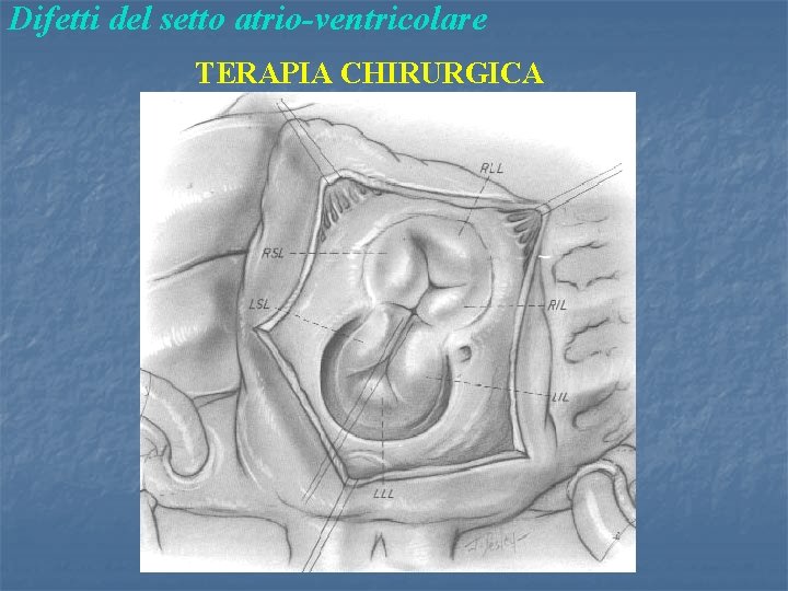 Difetti del setto atrio-ventricolare TERAPIA CHIRURGICA 