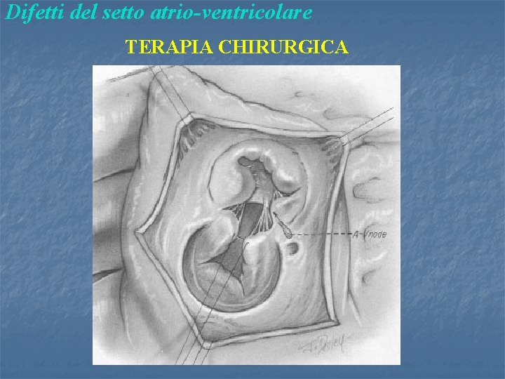 Difetti del setto atrio-ventricolare TERAPIA CHIRURGICA 