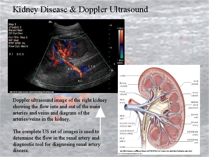 Kidney Disease & Doppler Ultrasound http: //www. ucdmc. ucdavis. edu/vascular/images/body/renal. jpg Doppler ultrasound image