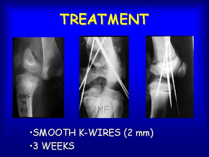 TREATMENT • SMOOTH K-WIRES (2 mm) • 3 WEEKS 